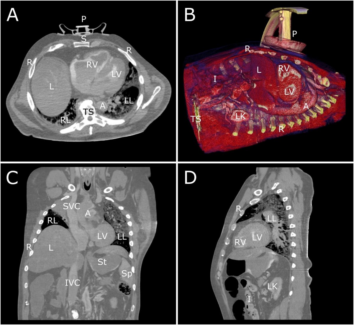 A three-dimensional 3-D chest computed tomography scan on the 17th