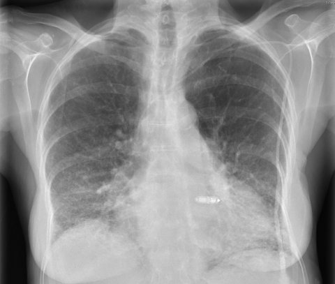 thorax x-ray