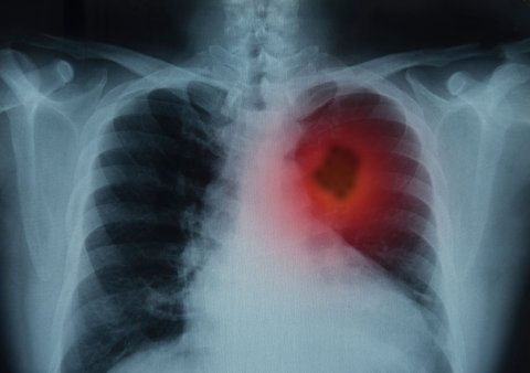 xray of human lungs with red spot indicating lung cancer