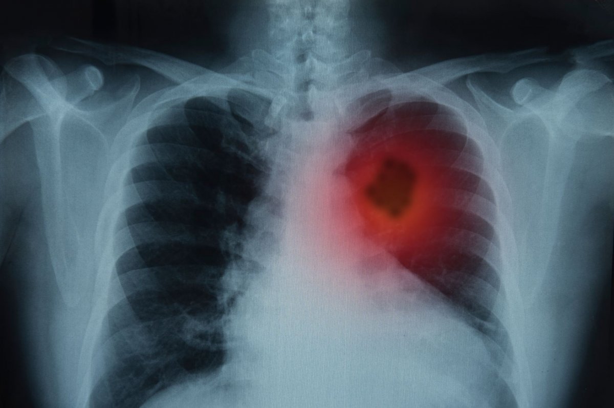 Cancer in Lungs X Ray - What Is It?