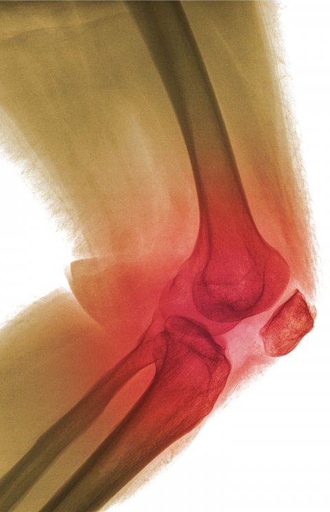 x-ray of human knee