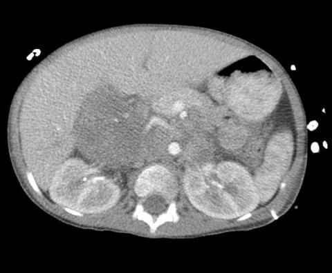 neuroblastoma ct scan in abdomen