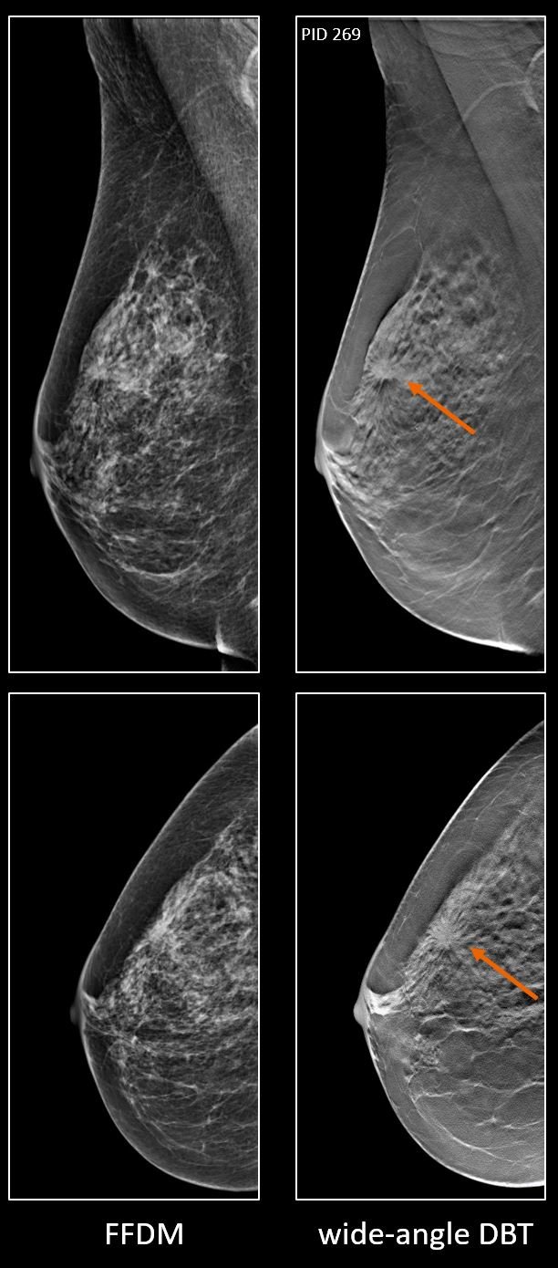 Breast cancer detection: advantage DBT •