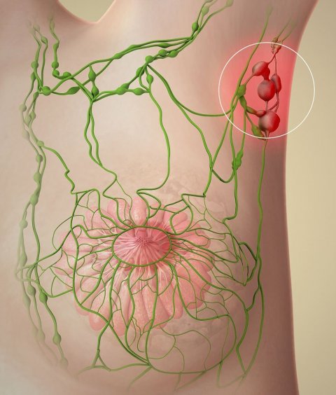 swollen armpit lymph nodes