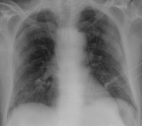 xray of human lung covid patient