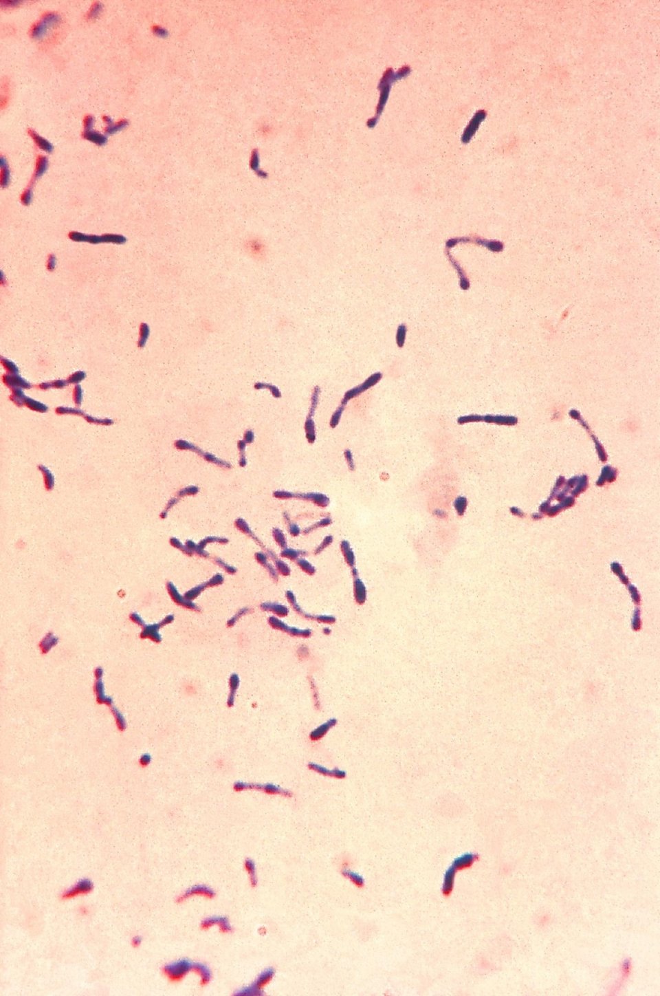Antibiotic resistance could make diphtheria ‘major global threat’ again ...