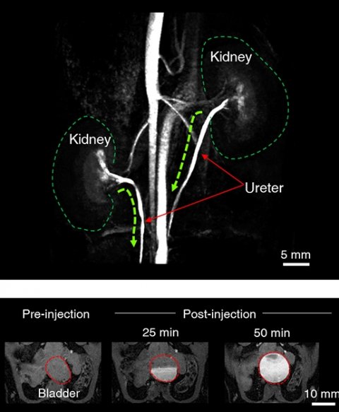 gadolinium mri