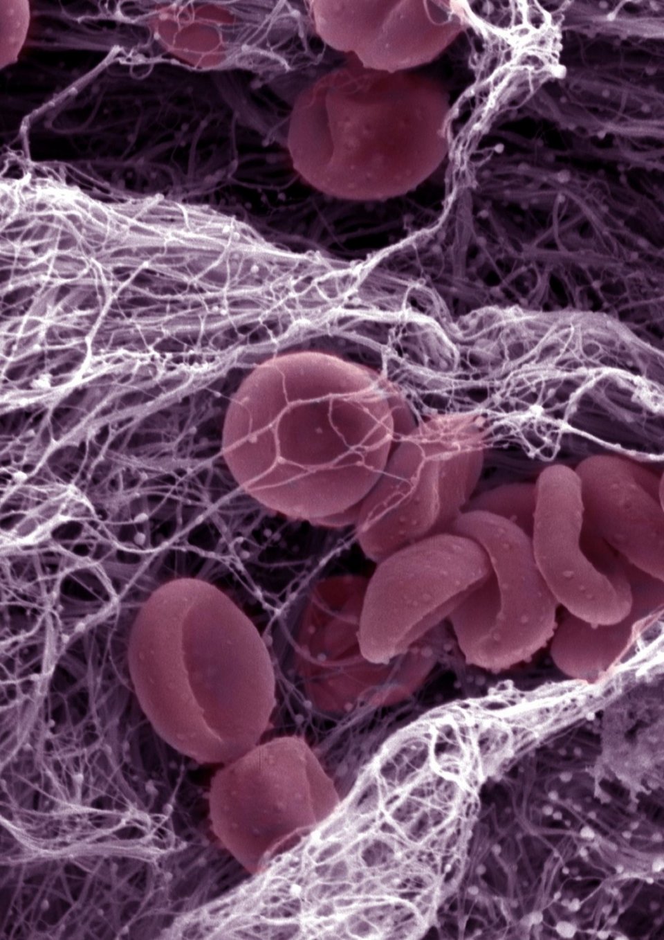 Covid19 Clinicians uncover rare blood clotting syndrome •