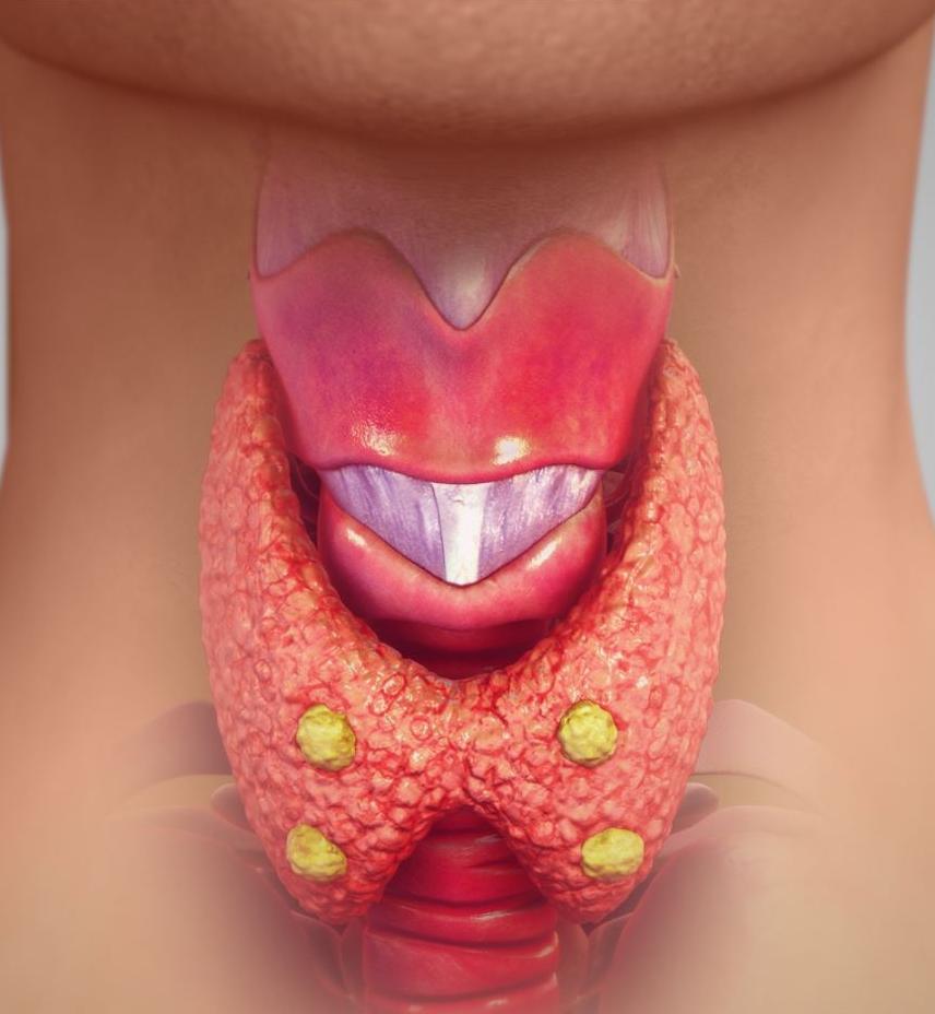 Schilddrüsenknoten ohne Narben oder Medikamente schrumpfen • healthcare