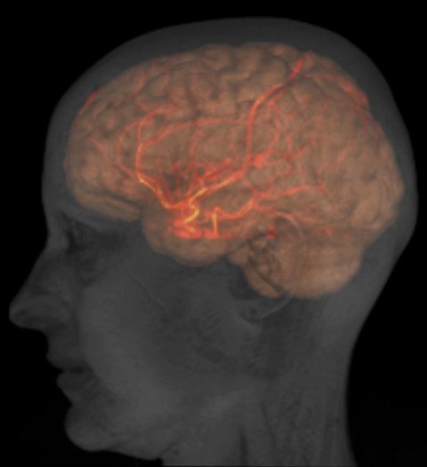 Head, brain and large arteries of a healthy female adult, MRI