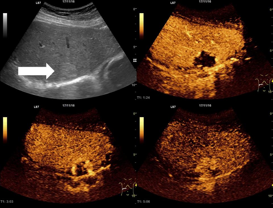 Medical societies support safety and benefits of ultrasound contrast ...