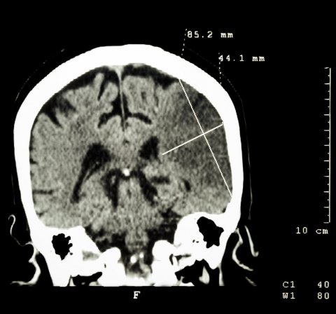 stroke in brain on ct scan