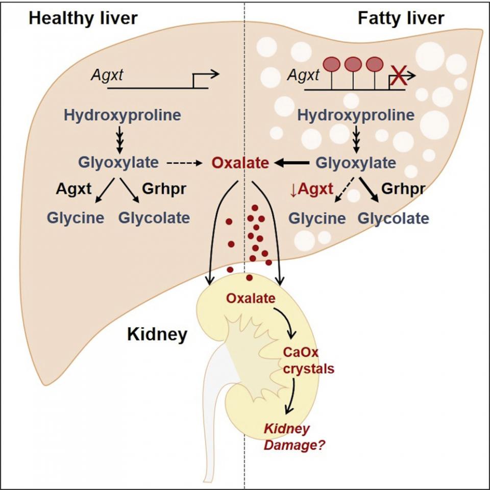 fatty-liver-disease-promotes-formation-of-kidney-stones-healthcare-in