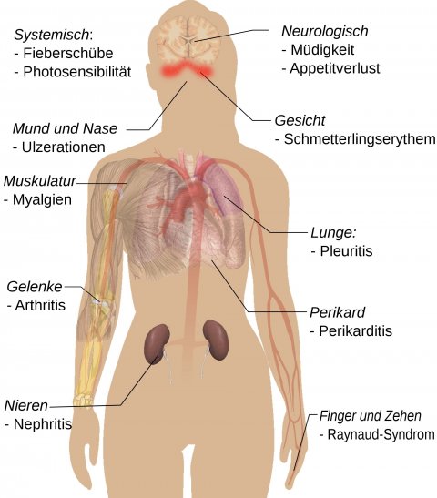 schematic of lupus erythematodes symptoms