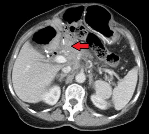 ct scan of pancreatic cancer