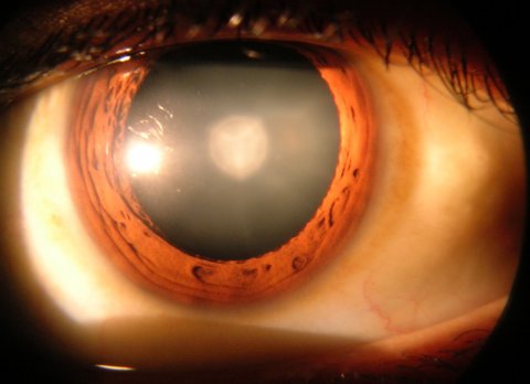 human eye with cataract