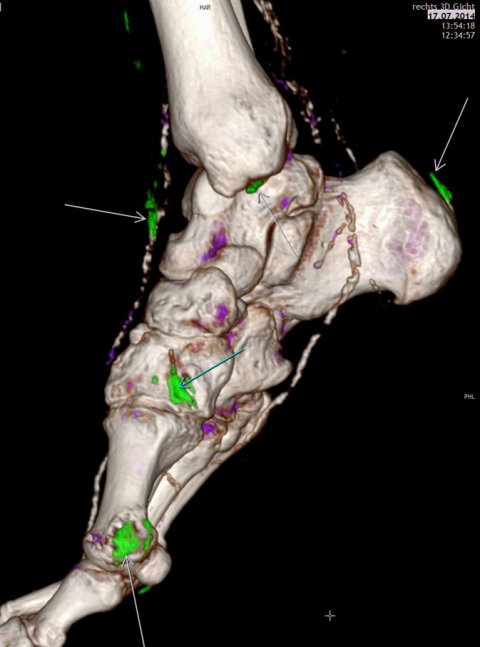 dual energy ct scan of foot of gout patient