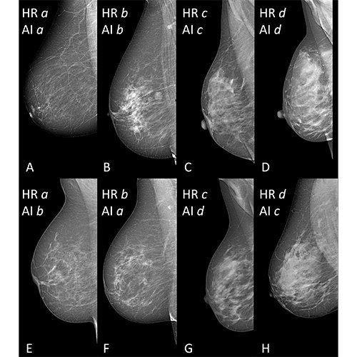 AI accurately classifies breast density •