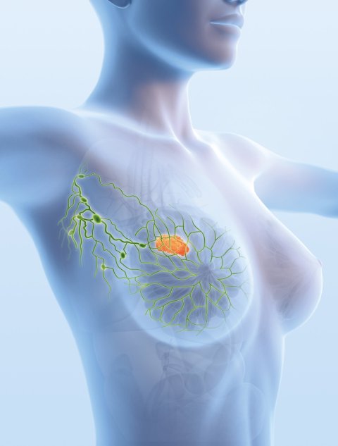 3d illustration of breast cancer and lymph nodes