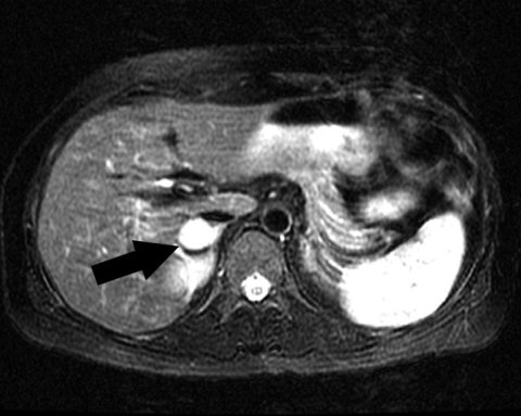 MRI of adrenal pheochromocytoma