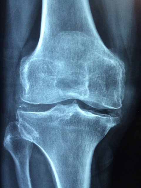 xray image of a knee joint
