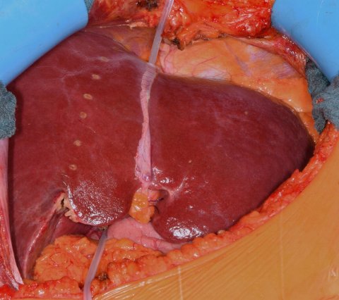 human liver prepared for transplantation