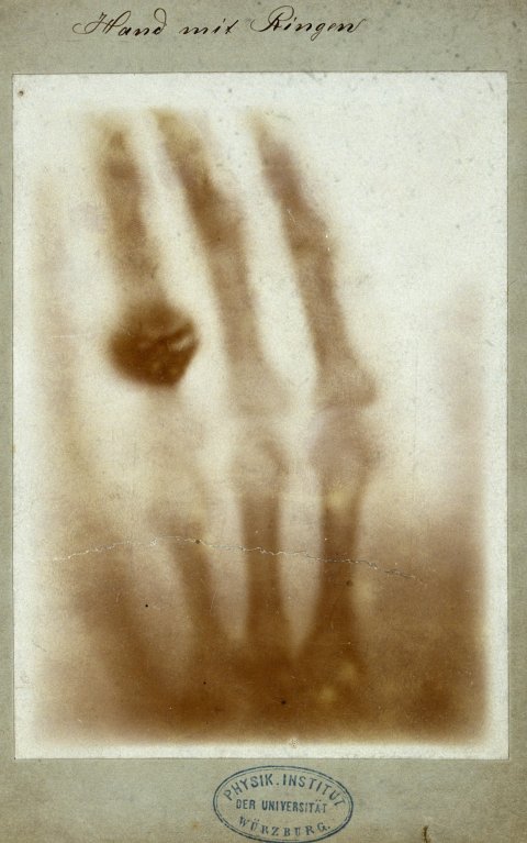 first xray of human hand