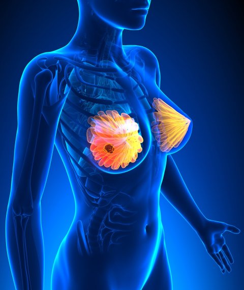 3d illustration of breast cancer