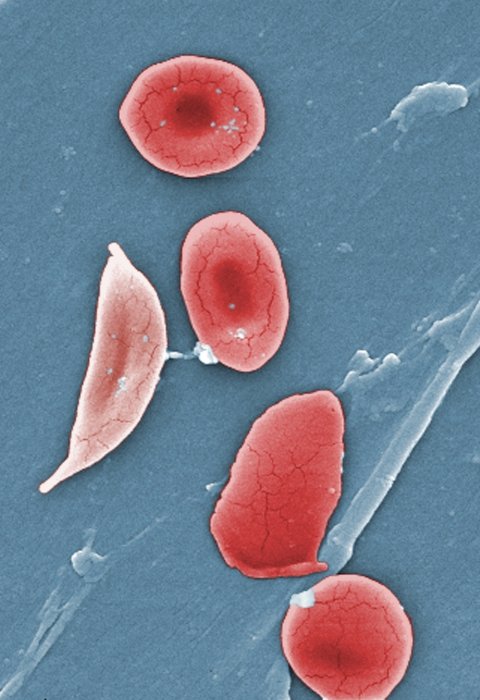 miscroscopic image of sickle cell disease