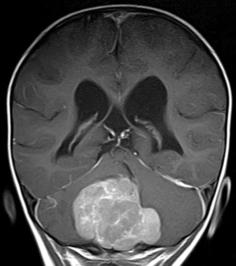 MRI image of human child's brain
