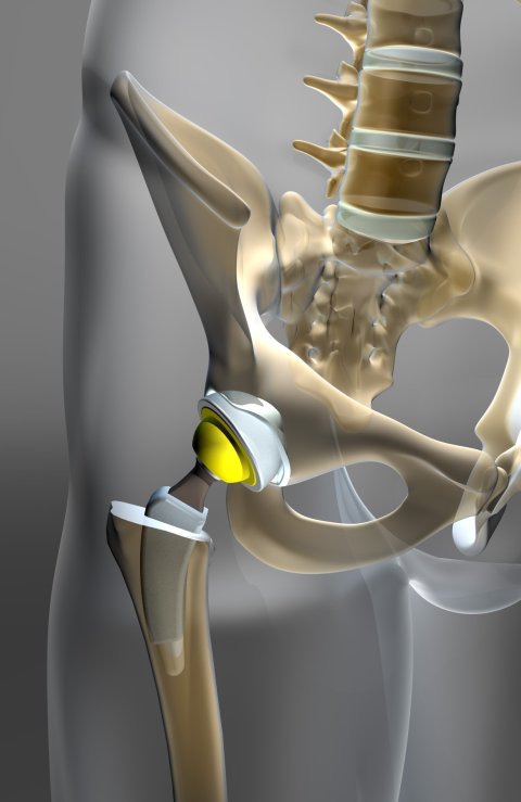 3d illustration of artificial hip implant