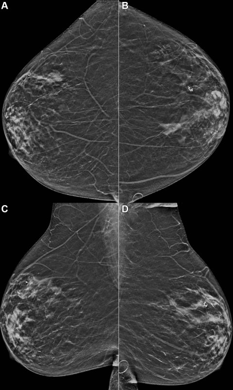 mammography scan of black woman's breasts