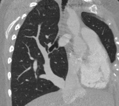 Chest CT of a patient with scimitar syndrome