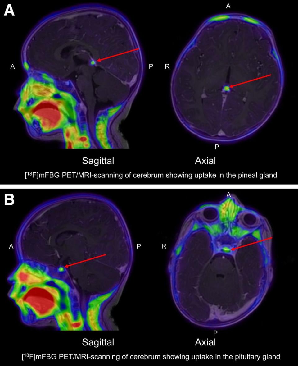 New PET/CT technique improves brain tumour detection in children ...