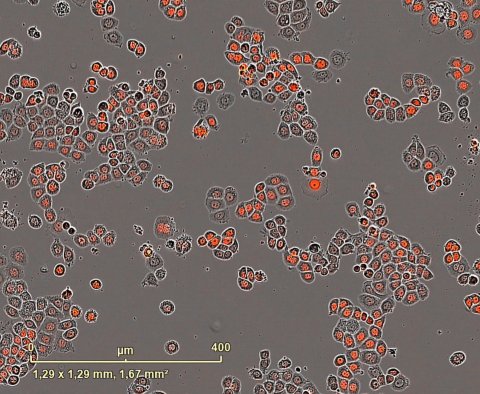 Triple-negative breast cancer cells under a microscope