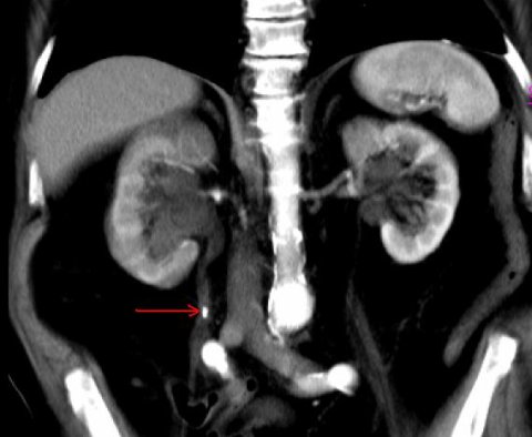 CT image of kidneys with kidney stone