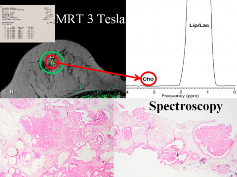 MRI with 3-T and spectroscopy