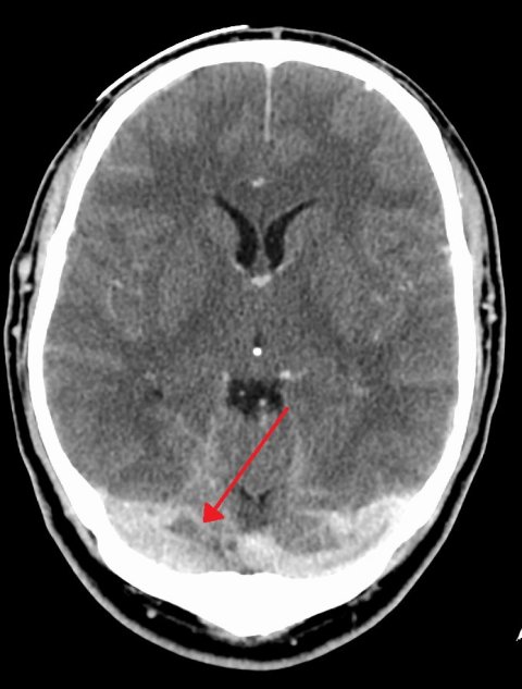 CT brain scan of a dural venous sinus thrombosis of the transverse sinus