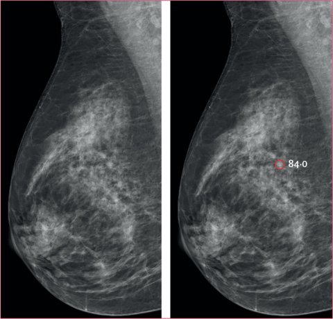 Two mammography images of a human breast. The right image features a red circle and number (84.0) from an AI-based cancer detection