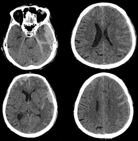 Four CT images of a human head, with intracranial bleeding from a stroke