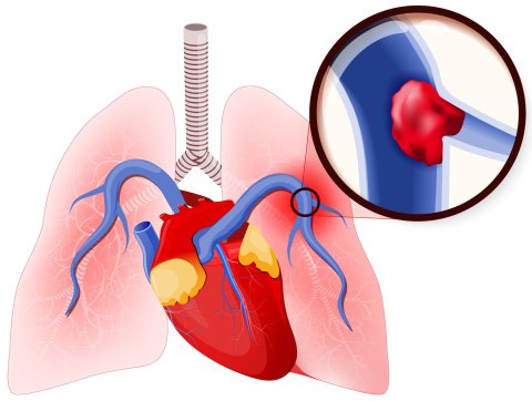Schematische Darstellung einer Lungenembolie