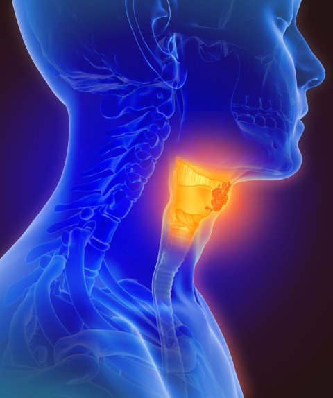 3D-Illustration eines Menschen mit Kopf-Hals-Tumor