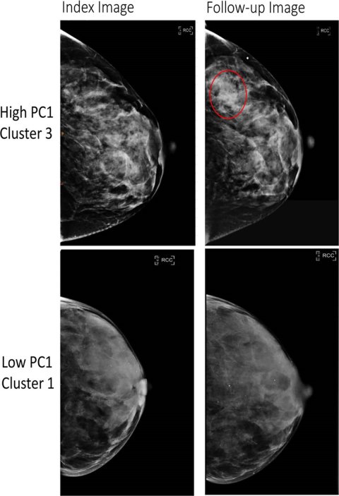 Four mammography breast scans arranged in a 2x2 grid