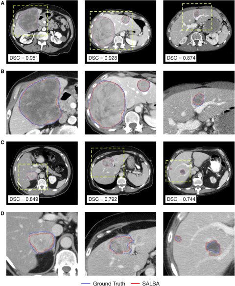 12 AI-labelled CT scans of liver cancer, arranged in a 3x4 grid