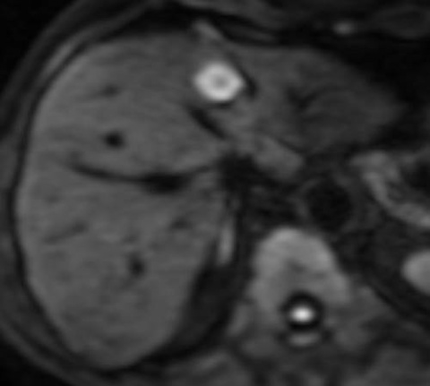 Diffusion weighted MR imaging