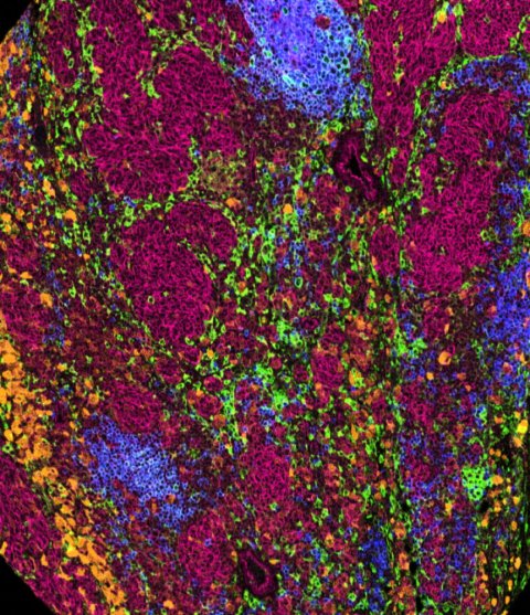 Multicolored cell patterns reveal the tumor profile of melanoma