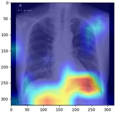 Xray of a human thorax, with AI-generated heatmap of the liver