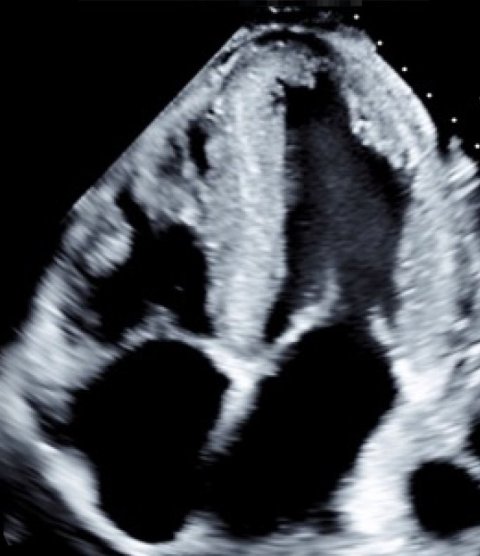 Screenshot from an echocardiogram video
