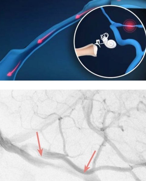Illustration eines Gehörgangs mit Tinnitus. Die untere Bildhältfe zeigt eine Angiografie mit verengten Gefäßen