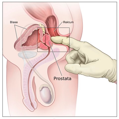 Schematische Darstellung der Tastuntersuchung der Prostata